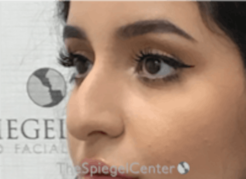 Non-Surgical Rhinoplasty / Nose Filler Before & After Gallery - Patient 167327 - Image 3