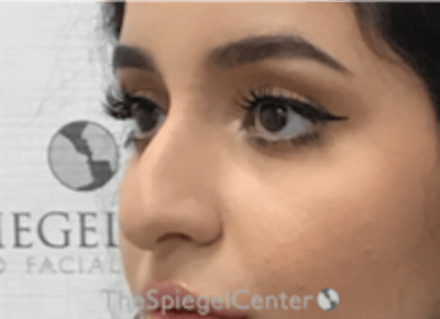 Non-Surgical Rhinoplasty / Nose Filler Before & After Gallery - Patient 167327 - Image 3