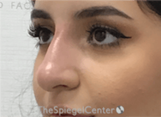 Non-Surgical Rhinoplasty / Nose Filler Before & After Gallery - Patient 167327 - Image 4