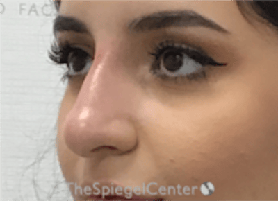 Non-Surgical Rhinoplasty / Nose Filler Before & After Gallery - Patient 167327 - Image 4