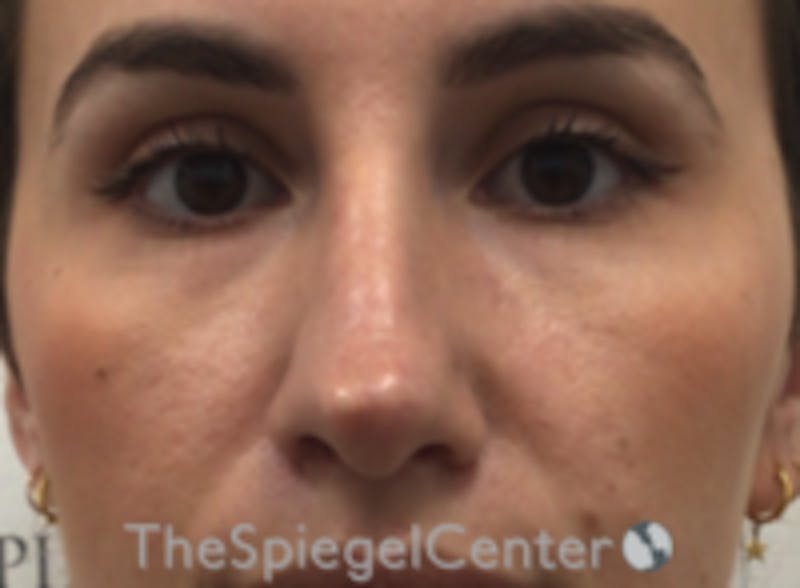 Non-Surgical Rhinoplasty / Nose Filler Before & After Gallery - Patient 615745 - Image 1