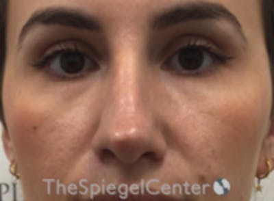 Non-Surgical Rhinoplasty / Nose Filler Before & After Gallery - Patient 615745 - Image 1