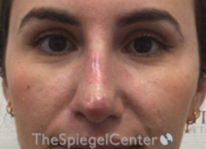 Non-Surgical Rhinoplasty / Nose Filler Before & After Gallery - Patient 615745 - Image 2