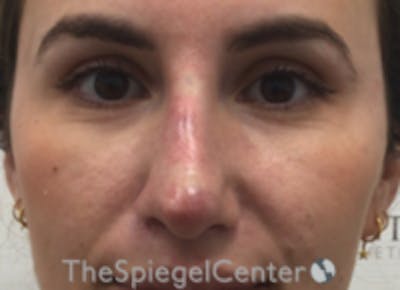 Non-Surgical Rhinoplasty / Nose Filler Before & After Gallery - Patient 615745 - Image 2