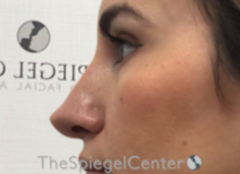 Non-Surgical Rhinoplasty / Nose Filler Before & After Gallery - Patient 615745 - Image 3