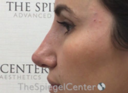 Non-Surgical Rhinoplasty / Nose Filler Before & After Gallery - Patient 615745 - Image 4