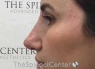 Non-Surgical Rhinoplasty / Nose Filler Before & After Gallery - Patient 615745 - Image 4
