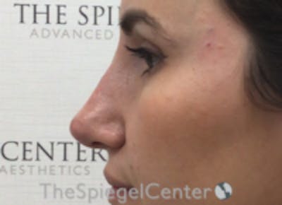 Non-Surgical Rhinoplasty / Nose Filler Before & After Gallery - Patient 615745 - Image 4