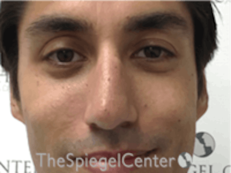 Non-Surgical Rhinoplasty / Nose Filler Before & After Gallery - Patient 123117 - Image 1