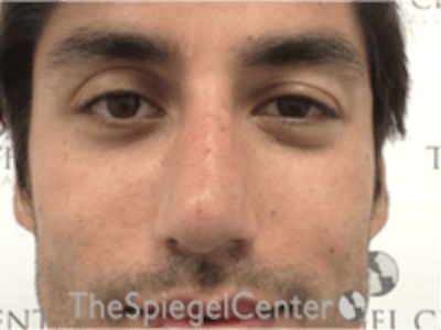 Non-Surgical Rhinoplasty / Nose Filler Before & After Gallery - Patient 123117 - Image 2