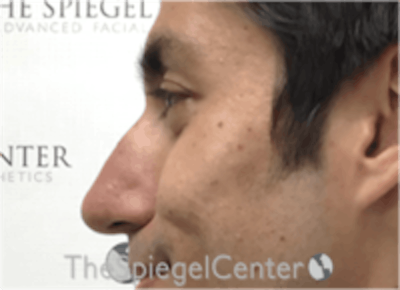 Non-Surgical Rhinoplasty / Nose Filler Before & After Gallery - Patient 123117 - Image 3