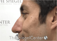 Non-Surgical Rhinoplasty / Nose Filler Before & After Gallery - Patient 123117 - Image 3