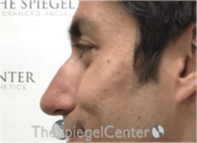 Non-Surgical Rhinoplasty / Nose Filler Before & After Gallery - Patient 123117 - Image 3