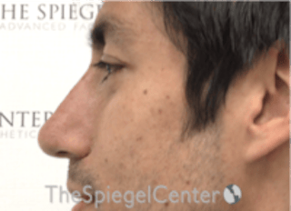 Non-Surgical Rhinoplasty / Nose Filler Before & After Gallery - Patient 123117 - Image 4