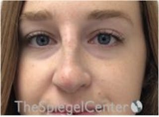 Non-Surgical Rhinoplasty / Nose Filler Before & After Gallery - Patient 162691 - Image 2