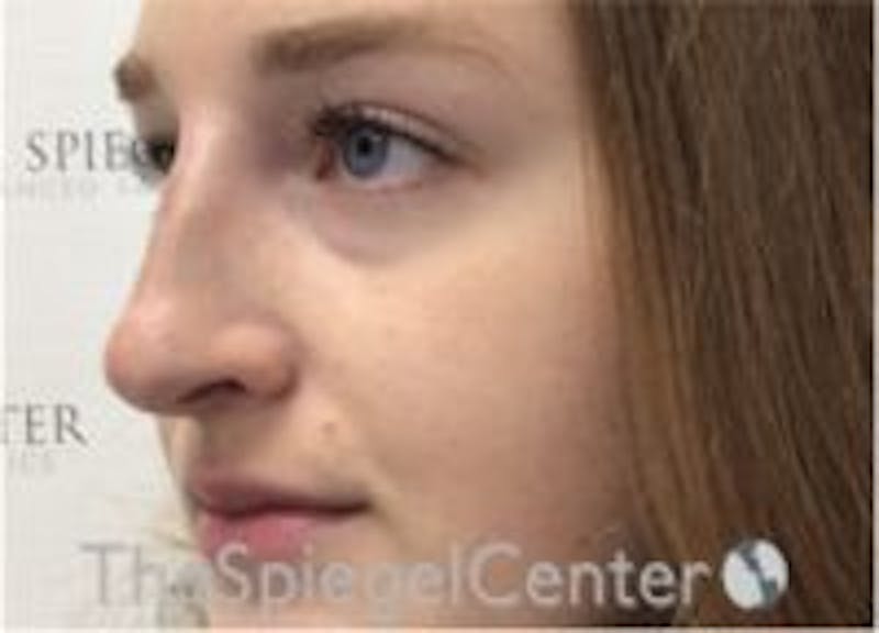 Non-Surgical Rhinoplasty / Nose Filler Before & After Gallery - Patient 162691 - Image 4