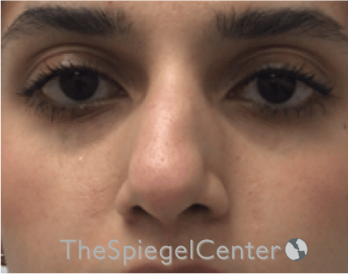 Non-Surgical Rhinoplasty / Nose Filler Before & After Gallery - Patient 372805 - Image 1