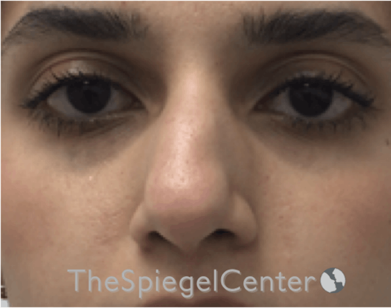 Non-Surgical Rhinoplasty / Nose Filler Before & After Gallery - Patient 372805 - Image 1