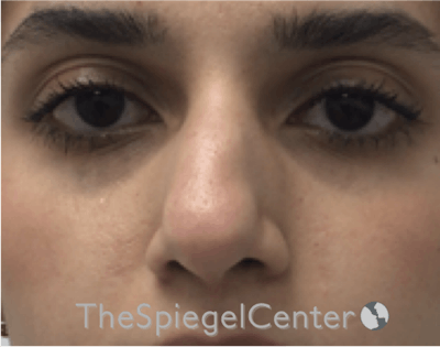 Non-Surgical Rhinoplasty / Nose Filler Before & After Gallery - Patient 372805 - Image 1