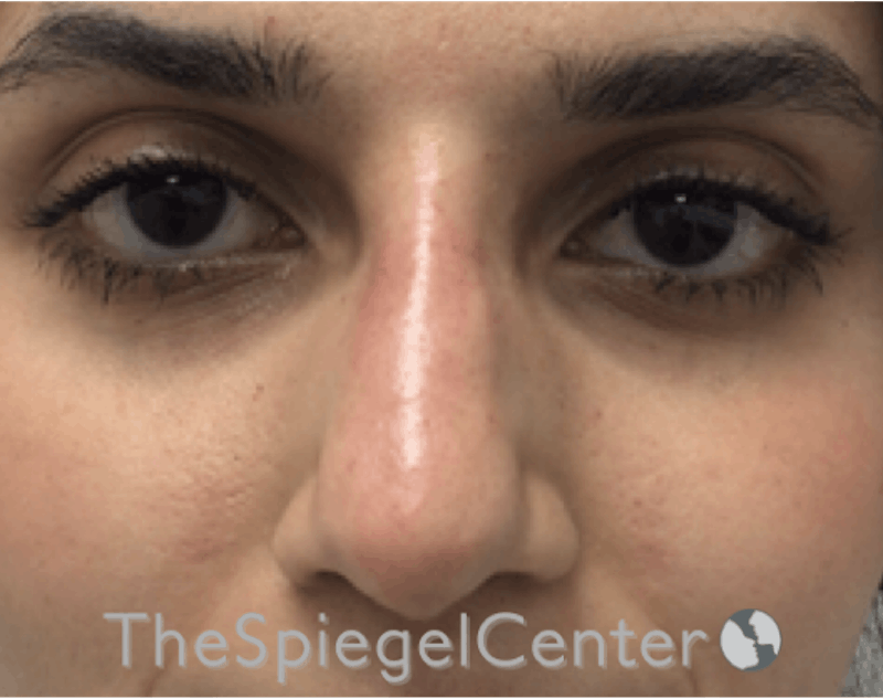 Non-Surgical Rhinoplasty / Nose Filler Before & After Gallery - Patient 372805 - Image 2