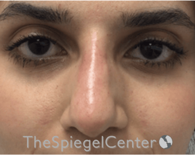 Non-Surgical Rhinoplasty / Nose Filler Before & After Gallery - Patient 372805 - Image 2