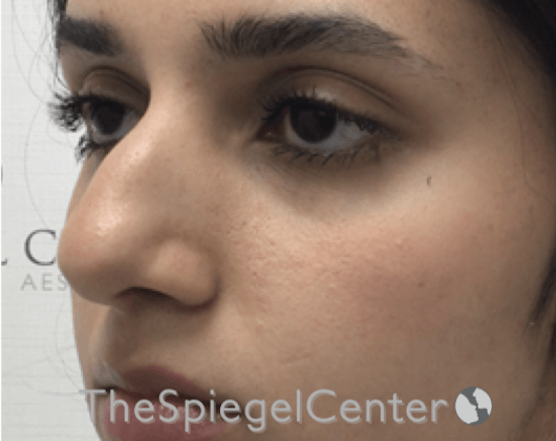 Non-Surgical Rhinoplasty / Nose Filler Before & After Gallery - Patient 372805 - Image 3