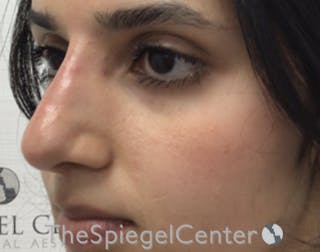 Non-Surgical Rhinoplasty / Nose Filler Before & After Gallery - Patient 372805 - Image 4