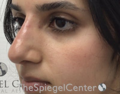 Non-Surgical Rhinoplasty / Nose Filler Before & After Gallery - Patient 372805 - Image 4
