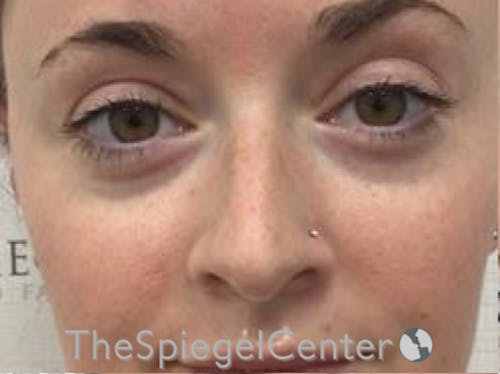 Non-Surgical Rhinoplasty / Nose Filler Before & After Gallery - Patient 104913 - Image 1