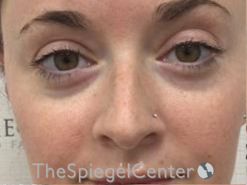 Non-Surgical Rhinoplasty / Nose Filler Before & After Gallery - Patient 104913 - Image 1