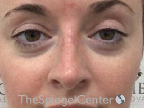 Non-Surgical Rhinoplasty / Nose Filler Before & After Gallery - Patient 104913 - Image 2