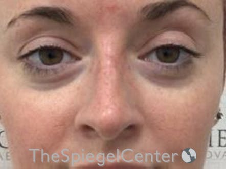 Non-Surgical Rhinoplasty / Nose Filler Before & After Gallery - Patient 104913 - Image 2