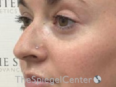 Non-Surgical Rhinoplasty / Nose Filler Before & After Gallery - Patient 104913 - Image 3