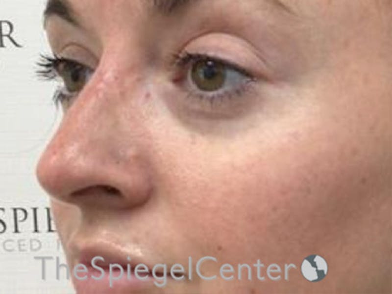 Non-Surgical Rhinoplasty / Nose Filler Before & After Gallery - Patient 104913 - Image 4