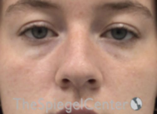 Non-Surgical Rhinoplasty / Nose Filler Before & After Gallery - Patient 153019 - Image 1