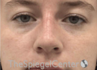 Non-Surgical Rhinoplasty / Nose Filler Before & After Gallery - Patient 153019 - Image 2