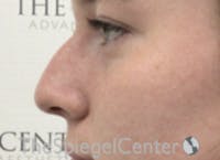 Non-Surgical Rhinoplasty / Nose Filler Before & After Gallery - Patient 153019 - Image 3