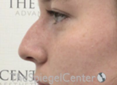 Non-Surgical Rhinoplasty / Nose Filler Before & After Gallery - Patient 153019 - Image 3