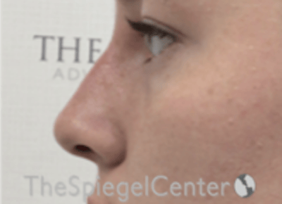 Non-Surgical Rhinoplasty / Nose Filler Before & After Gallery - Patient 153019 - Image 4
