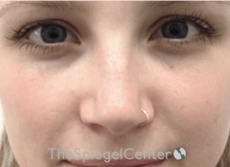 Non-Surgical Rhinoplasty / Nose Filler Before & After Gallery - Patient 615791 - Image 1