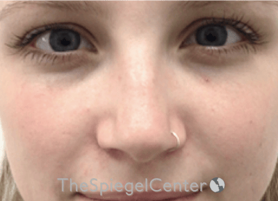 Non-Surgical Rhinoplasty / Nose Filler Before & After Gallery - Patient 615791 - Image 1