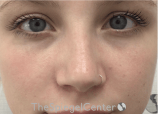 Non-Surgical Rhinoplasty / Nose Filler Before & After Gallery - Patient 615791 - Image 2