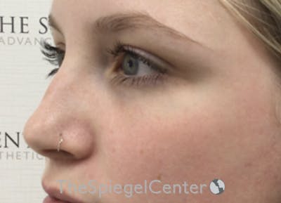 Non-Surgical Rhinoplasty / Nose Filler Before & After Gallery - Patient 615791 - Image 3