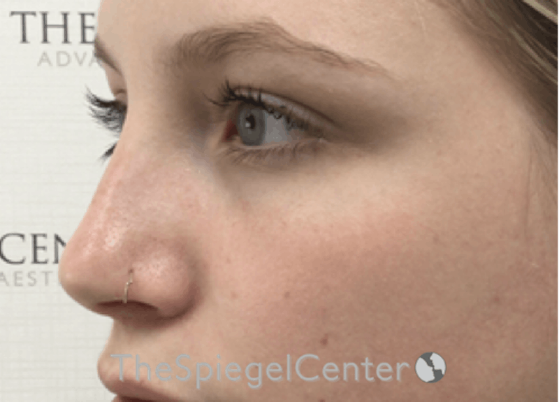 Non-Surgical Rhinoplasty / Nose Filler Before & After Gallery - Patient 615791 - Image 4