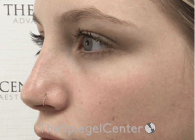 Non-Surgical Rhinoplasty / Nose Filler Before & After Gallery - Patient 615791 - Image 4