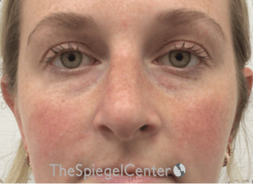 Non-Surgical Rhinoplasty / Nose Filler Before & After Gallery - Patient 351463 - Image 1