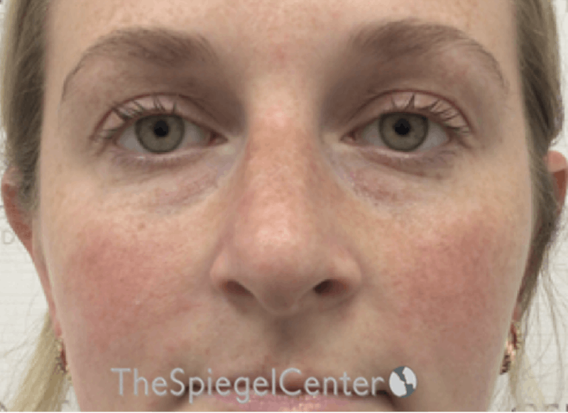 Non-Surgical Rhinoplasty / Nose Filler Before & After Gallery - Patient 351463 - Image 1