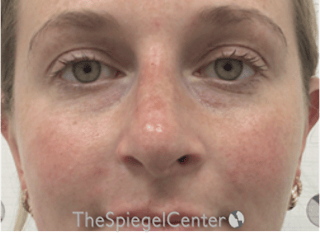 Non-Surgical Rhinoplasty / Nose Filler Before & After Gallery - Patient 351463 - Image 2
