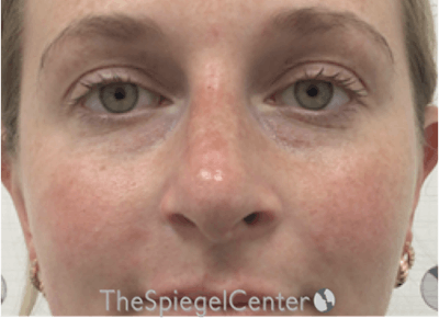 Non-Surgical Rhinoplasty / Nose Filler Before & After Gallery - Patient 351463 - Image 2
