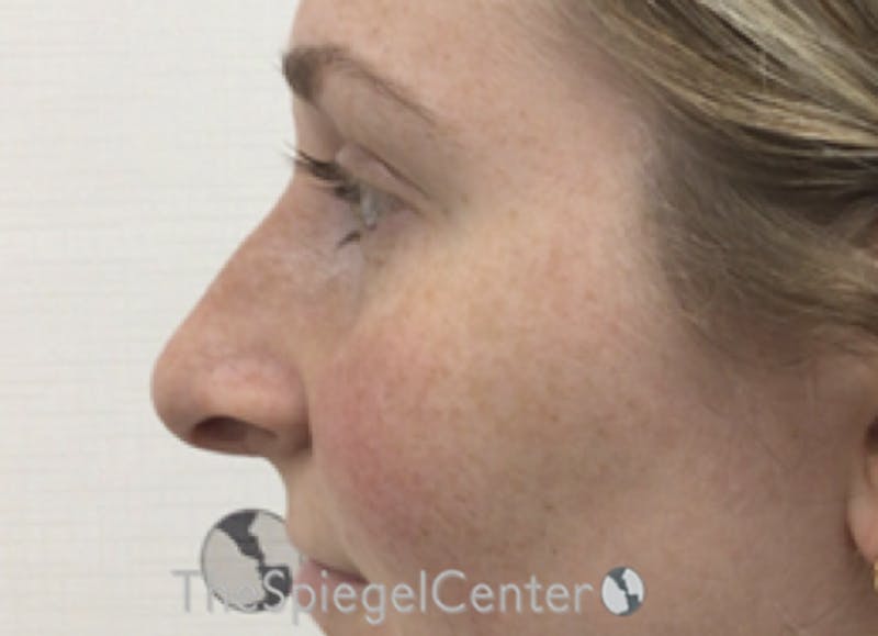 Non-Surgical Rhinoplasty / Nose Filler Before & After Gallery - Patient 351463 - Image 3